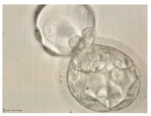 Transfered embryo Grade 5AA 1.22.08